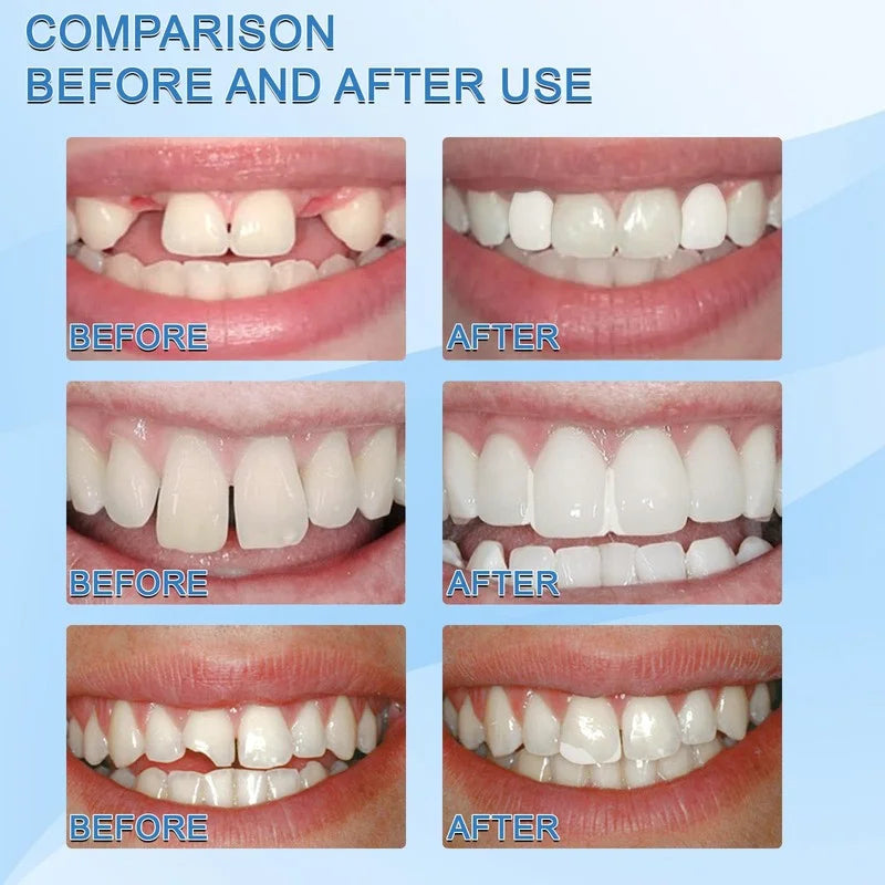 Temporary Tooth Repair Beads For Dentures Resin Adhesive