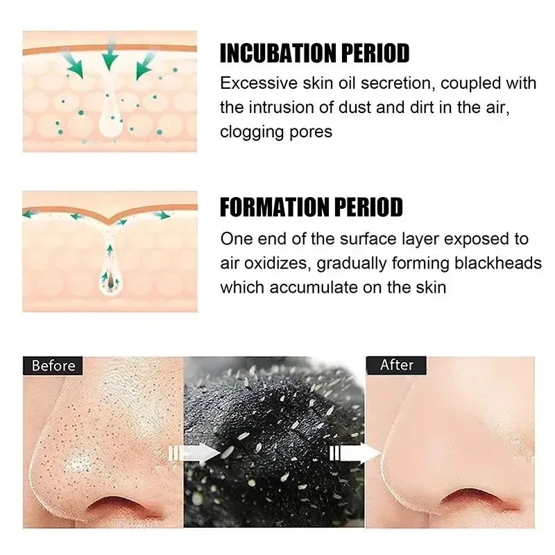 Suake Blackhead Remove Mask Stickers For Nose Pores